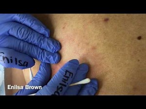 Enilsa has a new one! A back full of blackheads