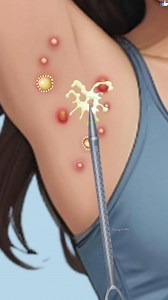 ingrown Extraction ASMR PimpleAcne Cleaning & Armpit Hair-Warms #animation #asmrvideo #cleaning #arm #reelschallenge Tunnig ASMR | Tunnig ASMR