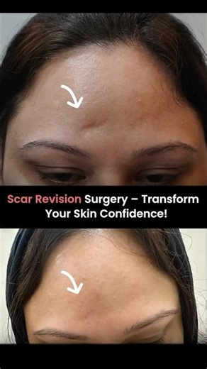 Scar Revision Surgery – Transform Your Skin Confidence | Scar Revision Surgery in Delhi #scarremoval