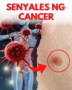 Mga Senyales Na May Tumutubong Cancer Sa Iyong Katawan. #cancer #cancersign | Go Organique Main