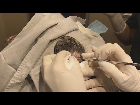 Dr. Pimple Popper Removes Big Cyst!