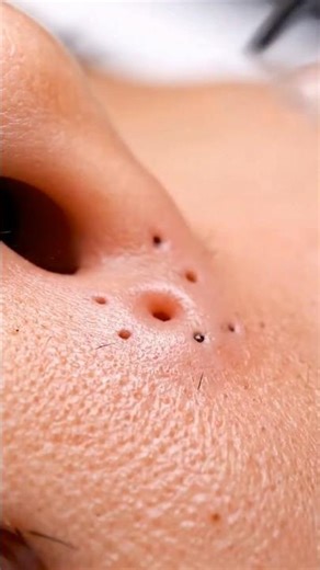 Extreme Upper Lip Blackhead Removal