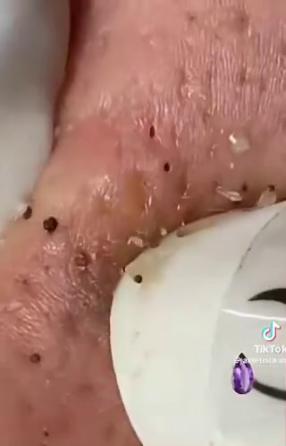 Fun fact 👀You can remove a blackhead perfectly, and it can still come back 😭Not because you did it wrong, but because your pore is still producing oil and shedding skin.Extraction removes it… it doesn’t stop it from forming 🤔