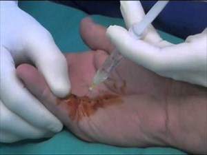 Dupuytren's Contracture Surgery - Needle Aponeurotomy