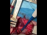 Tracheal Stenosis Extensive Resection in Pediatric  • Video • MEDtube.net