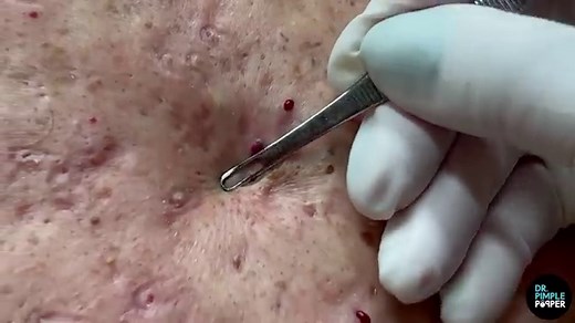 Dr. Pimple Popper Pops A Never-Ending ‘Blackhead Paradise’ In New Video