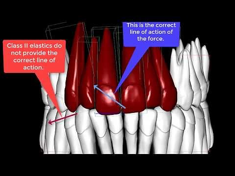 Midline correction from the posterior teeth