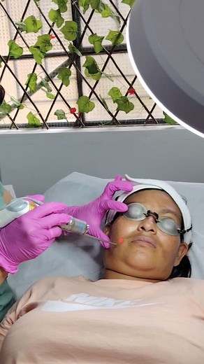 Láser Q switched para tratamiento de melasma. #consultoriodrapierinachavez #laserqswitched #pierinachavez #puertomaldonado #consultoriodermatologicodrapierinachavez | Pierina Laida Chavez Valera