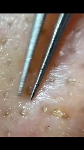 Satisfying Blackhead Removal ASMR