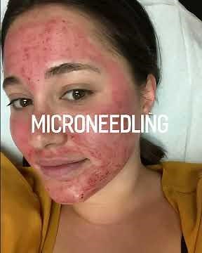 MicroNeedling - Collagen Induction Therapy