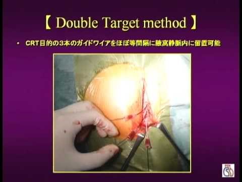 胸郭外穿刺法の概要