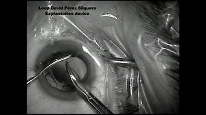 Explantation IOL Loop - Eyetube