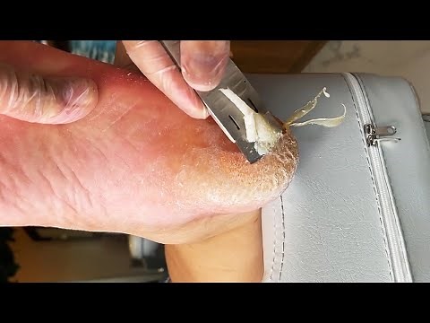 Remove crusty skin and calluses on feet | Satisfying & Relaxing Video#39