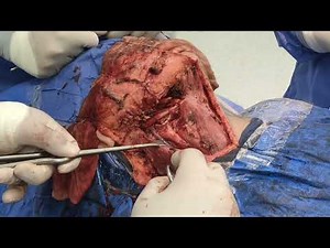 modified radical neck dissection by Dr. Mohamed Elshamaa