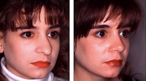 Rhinoplasty to Shorten a Long Nose 2: See This Young Woman's Before & After