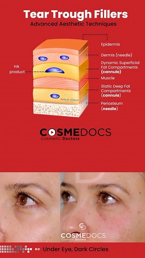 Advanced treatment of under eyes circle by injecting filler in multiple layers to be carried out by proficient practitioners only. #cosmedocs #harleystreetinstitute partnership delivers advanced aesthetic injectable training -#hsifellowprogram #aestheticmedicine #dermalfillertraining #botoxtraining ##DermalFillers #UnderEyeRejuvenation #YouthfulAppearance #NonInvasiveTreatment #InformativePost | Cosmedocs