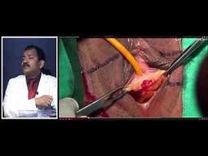 Tension Free Transvaginal Tape TVT and TVTO and TOT