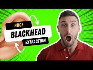 Big Blackhead Extraction from Ear! 6 minutes! #gross