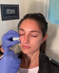 Using 1ml of dermal filler on our beautiful young patient to address...