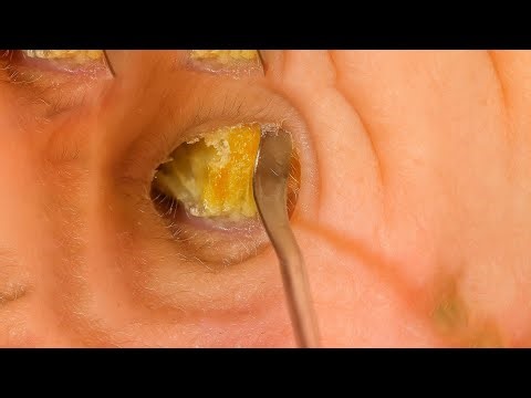 Massive Earwax Clump Extraction in HD