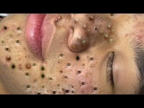Relaxing Skincare Routine Cleansing For Blackheads And Acne Removal Treatment #5058