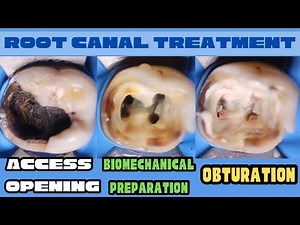 Root Canal Treatment 🔵 Mandibular Molar 🟡Access Opening🟢Biomechanical Preparation ⚪️ Obturation
