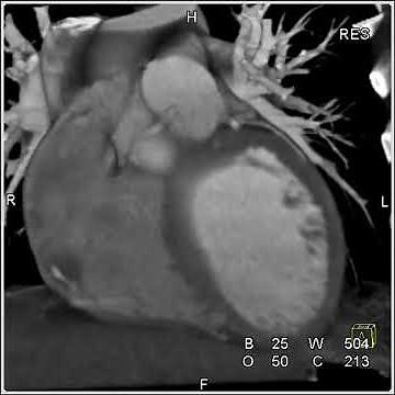 Cardiac: Right Coronary Artery (7 of 7)