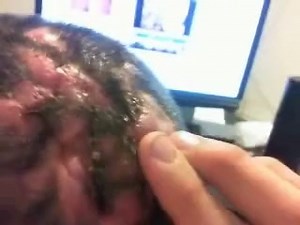 Disgusting pus oozing skin disease