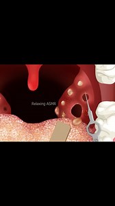 31K views · 193 reactions | Gentle ASMR Acne & Blackhead Removal Animation | Nikolas Bushi | Facebook