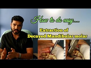 Extraction of mandibular first molar