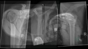 AC-Joint Arthroscopic Reconstruction Double Rope System