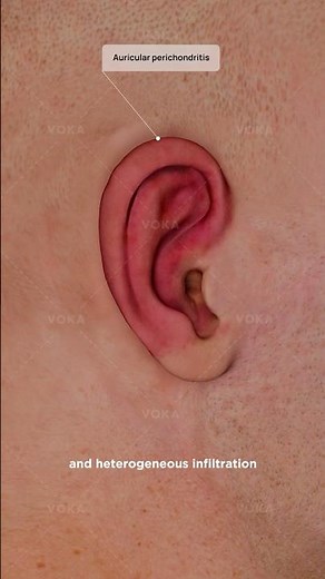 What is perichondritis of the auricle and why should you care? Explained in 3D