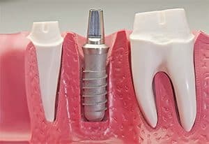 Dental Implants Campbelltown - A Plus Dental