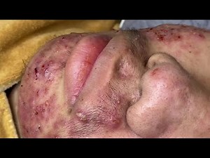 Extreme Acne & Pimple Popping Treatment | Deep Cleaning Session