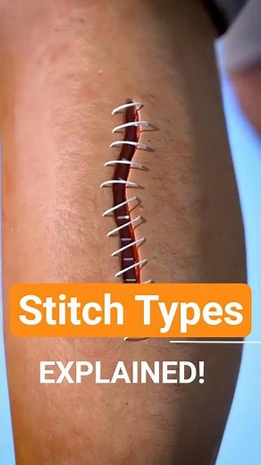 Types of Stitches | Which Stitches Heal Faster? | Simple vs Complex Stitches Explained!