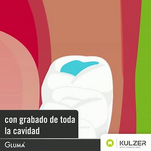 🔬🦷 Es bueno saber 🔬🦷 Gracias a su fórmula inteligente puedes utilizar GLUMA Bond Universal en las diferentes técnicas de grabado #AdhesiónDental #GLUMABondUniversal #SomosKulzer #Kulzer 🦷💚 #Odontología #GLUMA #AdhesivoDental #KulzerDental #Teeth #MakingSmiles #DentalLife #Dental #Dentistry | Kulzer México