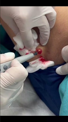 Meet Charlie 👋 #drpimplepopper #popaholics