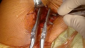 Latarjet Procedure: "From Patient Positioning to Skin Closure"