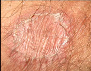 Imagens de Micose da virilha (Tinea Cruris) - Pele-Problemas-E-Tratamentos 2026