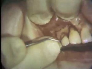 Lateral Sliding Flap