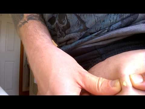 12 Year old sebaceous cyst removal. GROSS!!