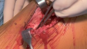 Makoplasty Partial Knee Replacement