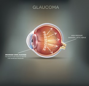 What is Glaucoma