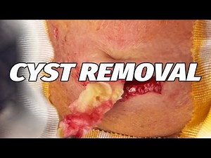 Calcula Neck Cyst! 2025's Latest Removal Video