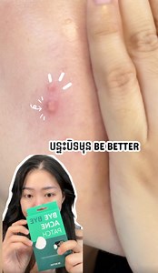 1.3M views · 27K reactions | កើតមុនដល់ចាស់ម៉ងខ្ញ៉ំ តែព្យាយាមក៉ំឲ្យស្នាមធំ និង ជ្រៅ ✨ចឹងឆាប់បាត់ទៅវិញ BE BETTER Pimple patch ផលិតតនៅកូរ៉េ  | YI Beauty Store | Facebook