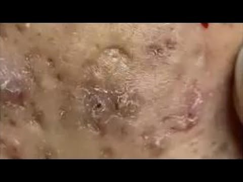 Extreme Blackhead Removal on Cheeks 😲 Close Up Blackhead/Whitehead Extraction