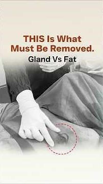 GYNECOMASTIA Surgery: Fat vs Gland | Why Gland Removal Is Essential