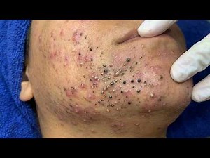 Blackhead Removal With Sac Dep Spa @424