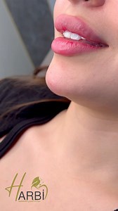 Lip Filler is our passion ..✨ Book your appointment now at AlHarbi Specialty clinics ☎️0775500076 | Al Harbi Specialty clinics عيادات الحربي التخصصيه