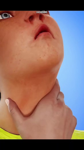 📌Detail Faktanya: Alien Hand Syndrome adalah gangguan neurologis langka yang pertama kali didokumentasikan secara medis pada awal abad ke-20 dan banyak diteliti di berbagai rumah sakit neurologi di negara seperti Amerika Serikat, Inggris, dan Jerman. Kondisi ini bukan cerita fiksi, melainkan gangguan nyata yang biasanya muncul setelah kerusakan pada bagian otak seperti corpus callosum, area yang menghubungkan sisi kanan dan kiri otak. Beberapa kasus tercatat terjadi setelah pasien mengalami str